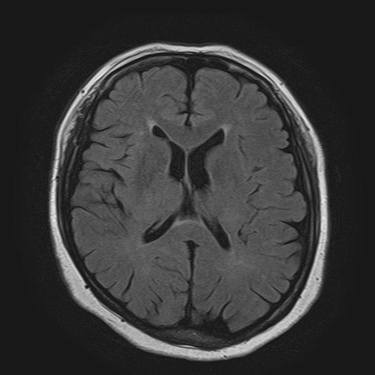 MRI：正常な脳の画像と脳の血管